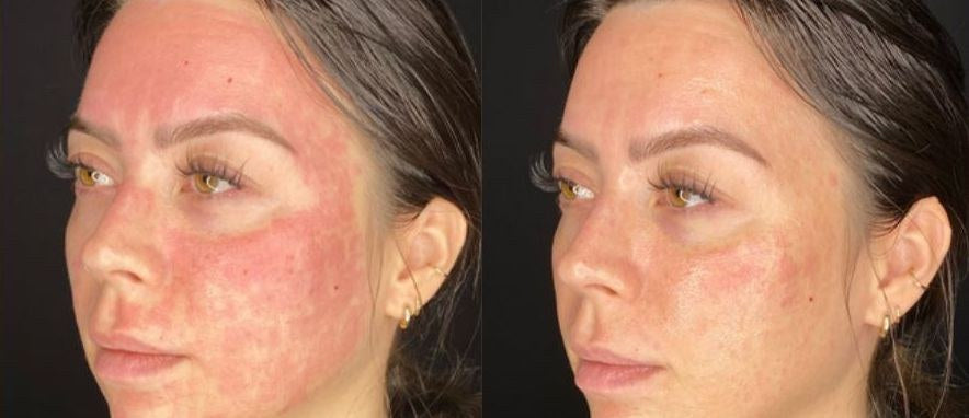 Before and after: post-procedure facial redness, then calmer skin with Elevai Empower