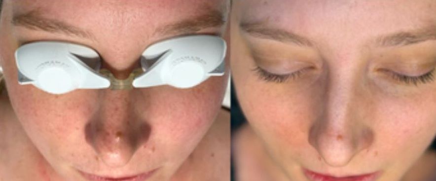 Before and after: skin during a light-based treatment, then calmer skin with Elevai Empower