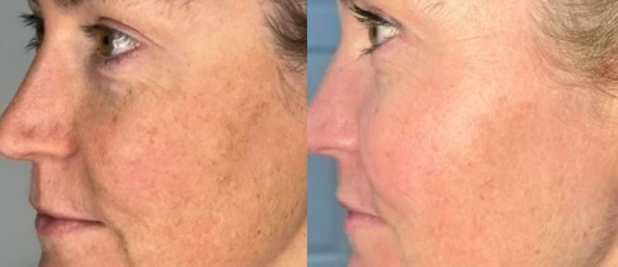 Before and after: uneven tone on cheek, then smoother-looking skin with Elevai Empower